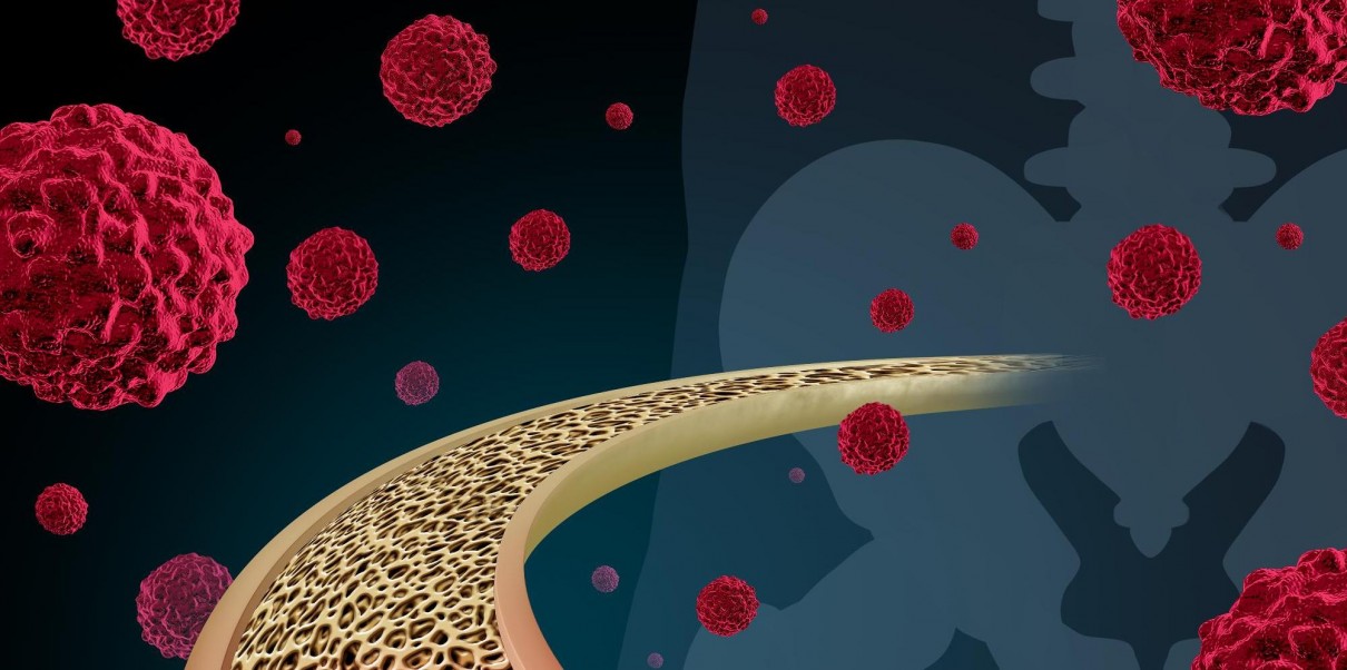 Cervical Cancer Prognosis And Survival Rate BOOKIMED cervical-cancer-prognosis-and-survival-rate-bookimed