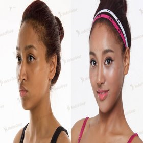 Before and after Rhinoplasty (nose job) photos by Dr. 