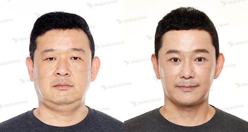 Before and after blepharoplasty results at JK Plastic Surgery Center, eyelid correction outcome