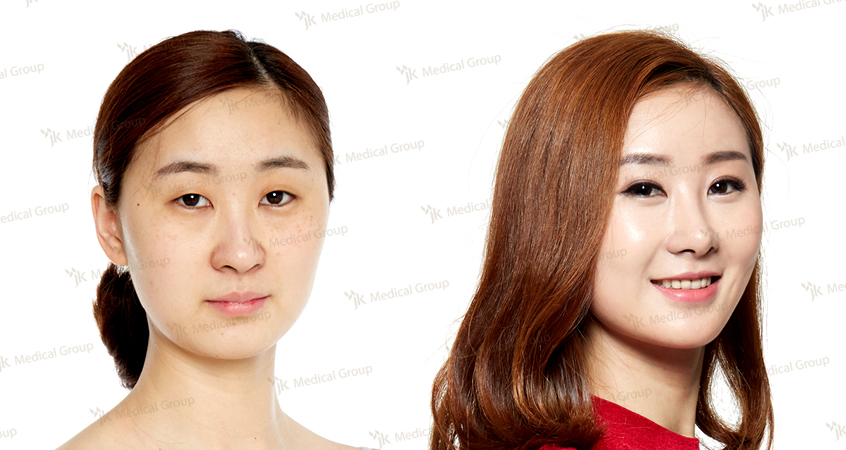 Resultados de blefaroplastia antes y después en JK Plastic Surgery Center, corrección de párpados