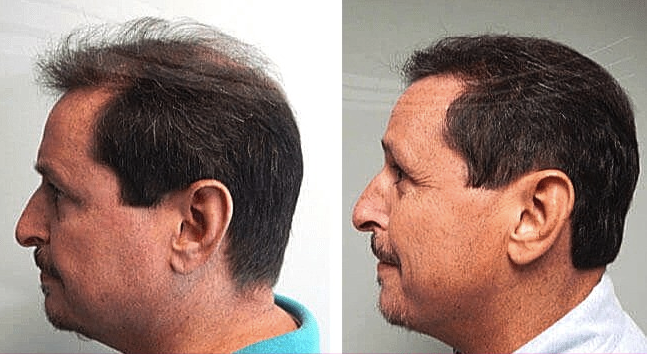 Resultados antes y después de trasplante capilar en Proesthe Hair Transplant Center, mayor densidad