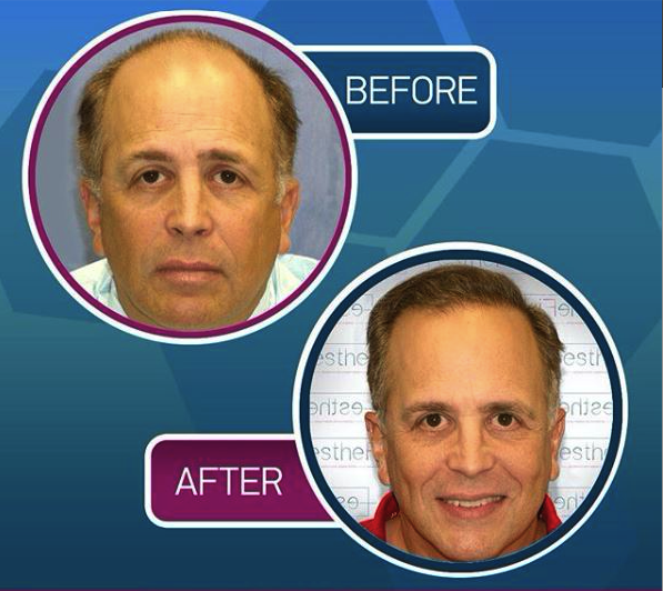 Результаты пересадки волос до и после в Proesthe Hair Transplant Center, восстановленная линия волос