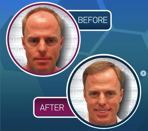 Результат до і після пересадки волосся FUE в Proesthe Hair Transplant Center, густіша лінія