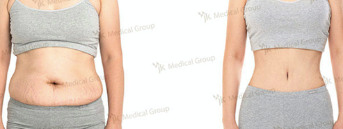نتائج شد البطن قبل وبعد في JK Plastic Surgery Center – تحسين شكل البطن