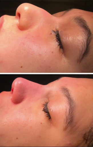 نتائج عملية تجميل الأنف قبل وبعد في Adem and Havva Medical Center، تحسين شكل الأنف