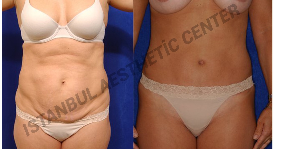 Resultados de abdominoplastia antes y después en Istanbul Aesthetic Plastic Surgery Center, abdomen plano