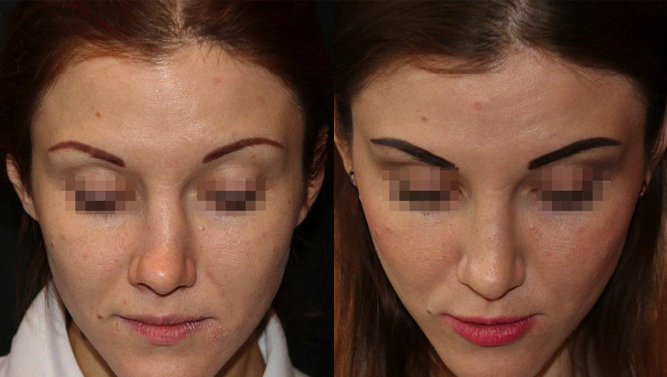 Resultados de rinoplastia antes y después en la Academia Ucraniana de Cirugía Plástica