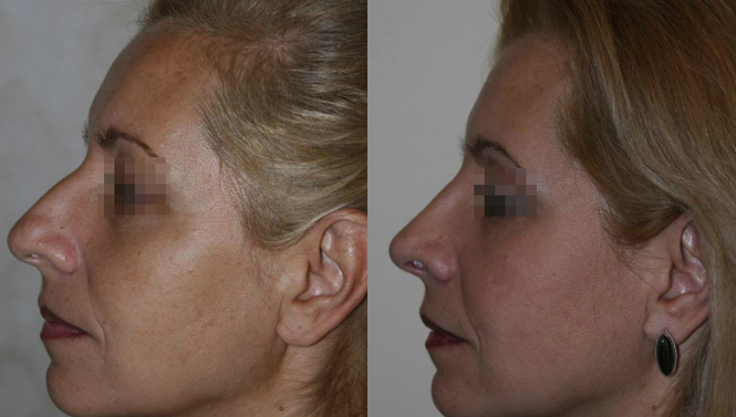 Resultados de rinoplastia antes y después en Ukrainian Academy of Plastic Surgery, remodelación nasal