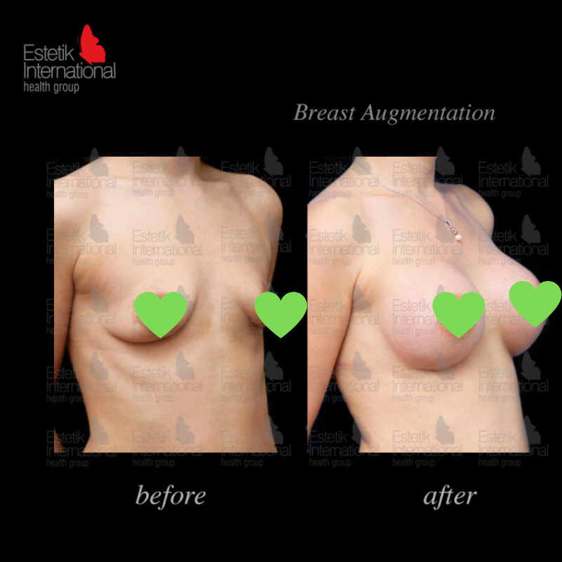 Before and after breast augmentation results at Estetik International Istanbul, fuller breasts