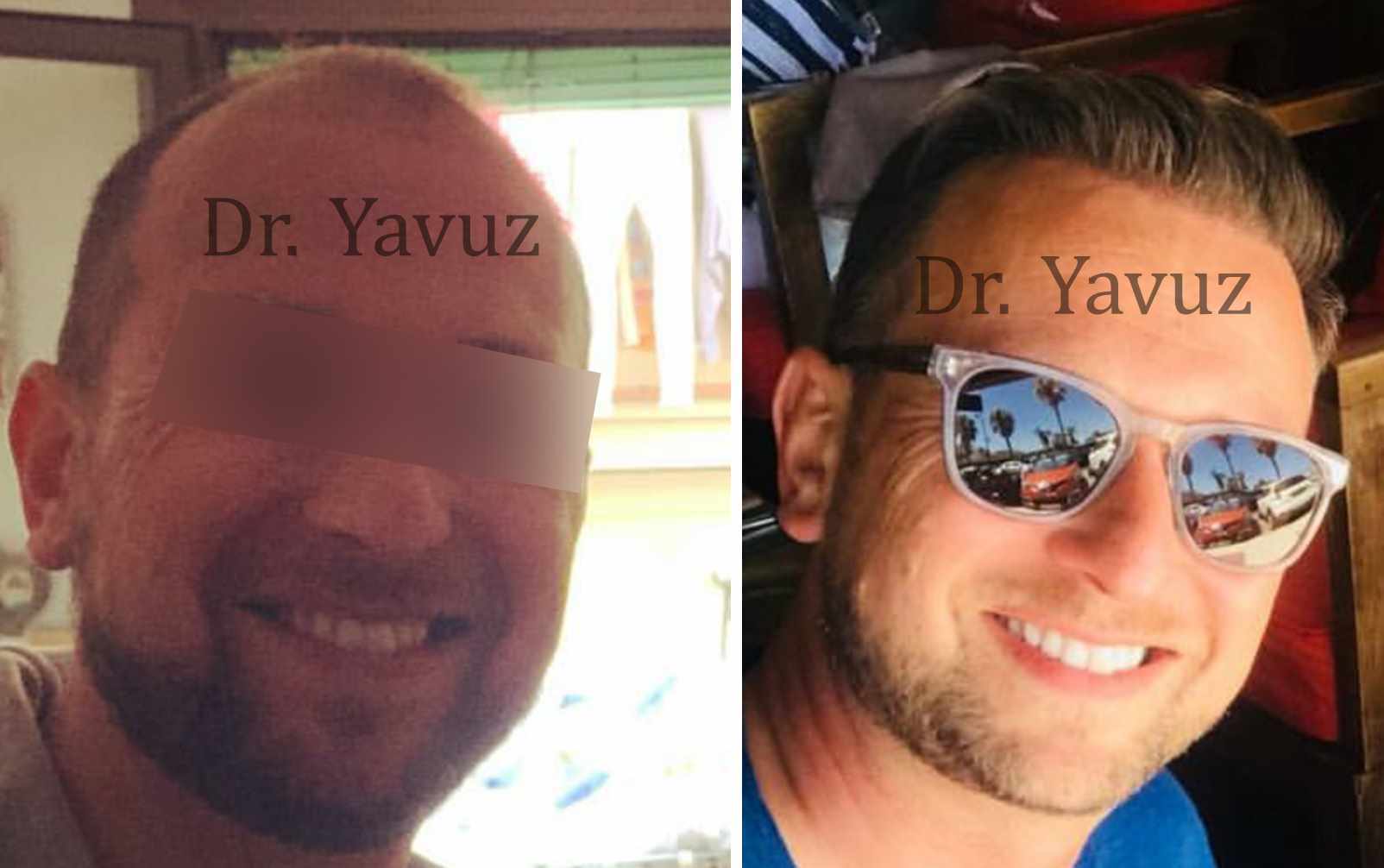 Resultado antes y después de trasplante capilar FUE en Dr. Ziya Yavuz Hair Transplant Clinic