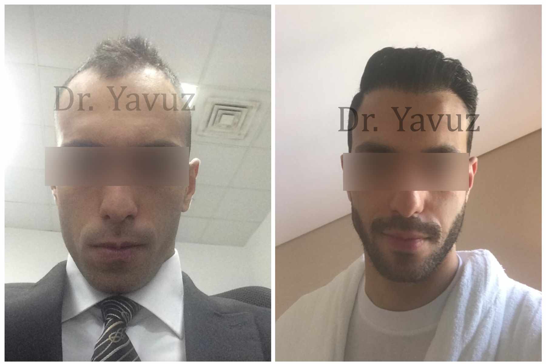 Результаты до и после пересадки волос FUE в клинике Dr. Ziya Yavuz, густая линия волос