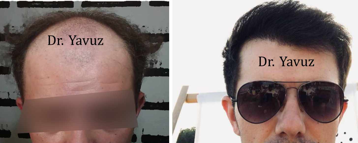 Before and after FUE hair transplant results at Dr. Ziya Yavuz Hair Transplant Clinic