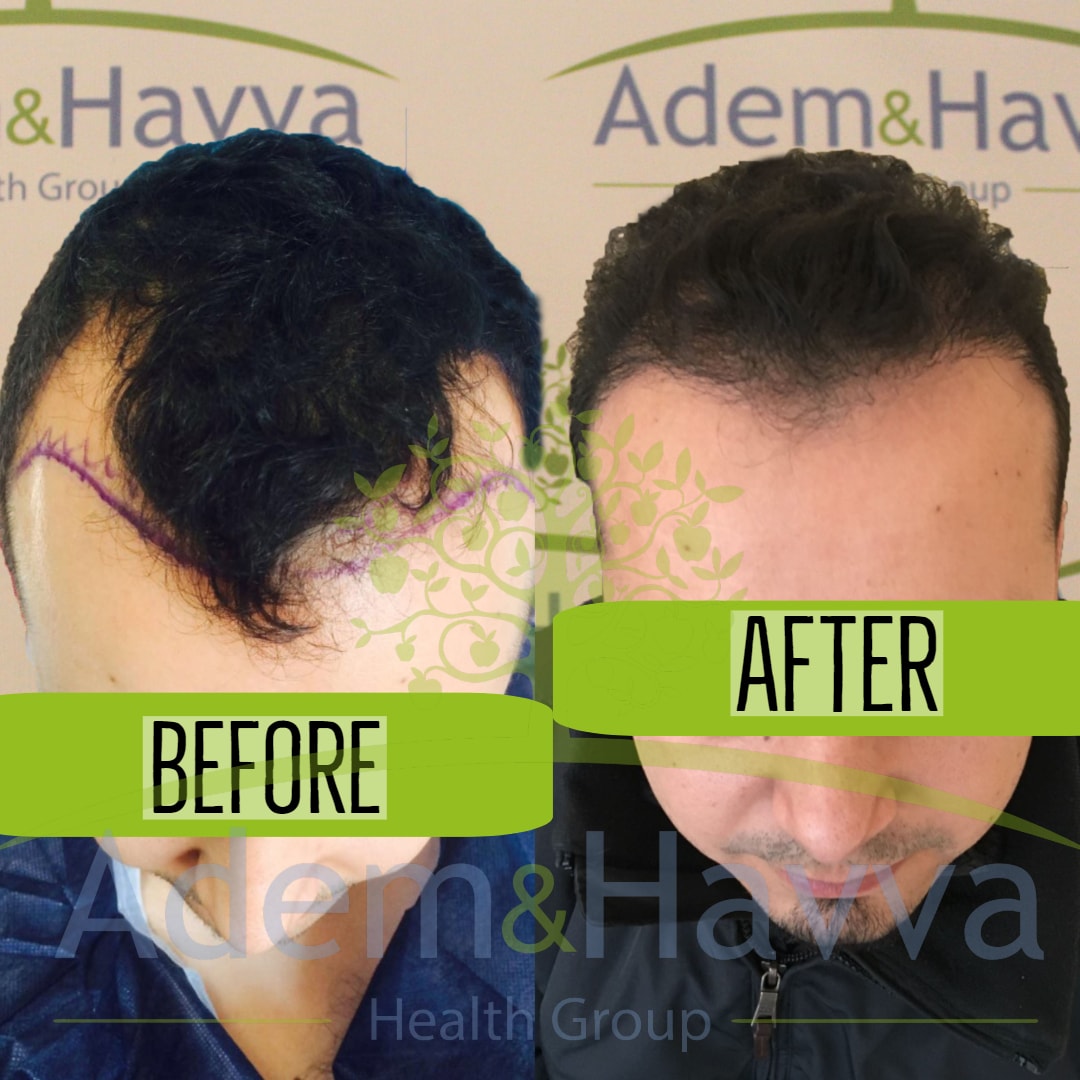 Resultados de trasplante capilar FUE antes y después en Adem and Havva Medical Center, línea mejorada