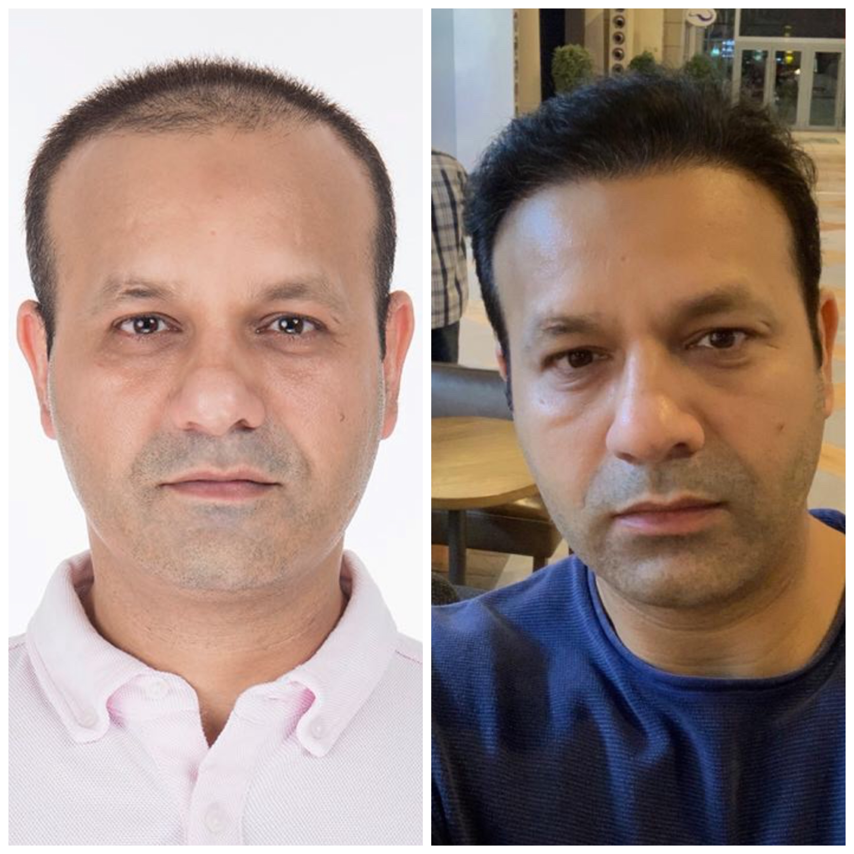 نتائج زراعة الشعر FUE قبل وبعد في عيادة Suzermed مع خط شعر أكثر كثافة