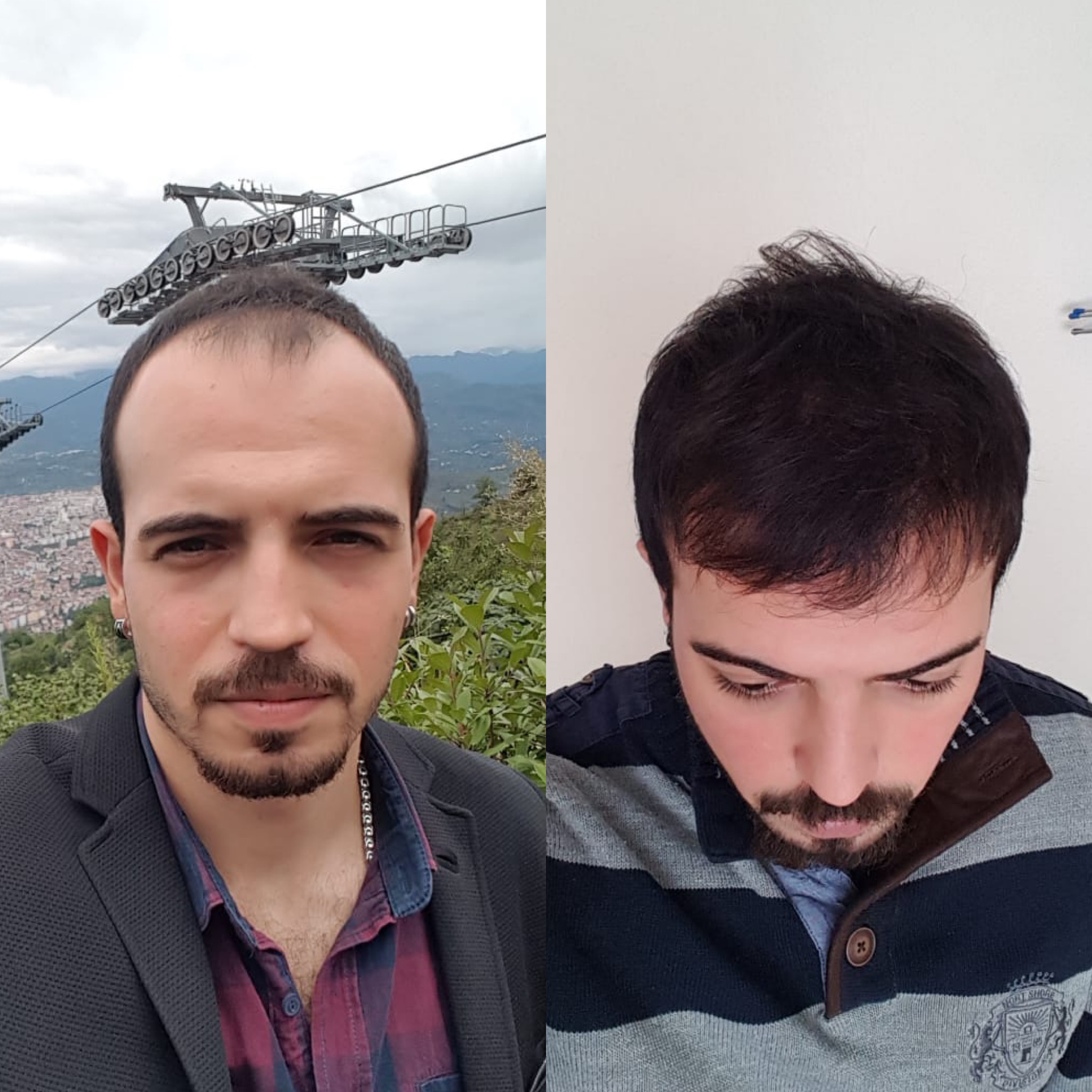 نتائج قبل وبعد زراعة الشعر FUE في عيادة Suzermed، استعادة خط الشعر للمريض