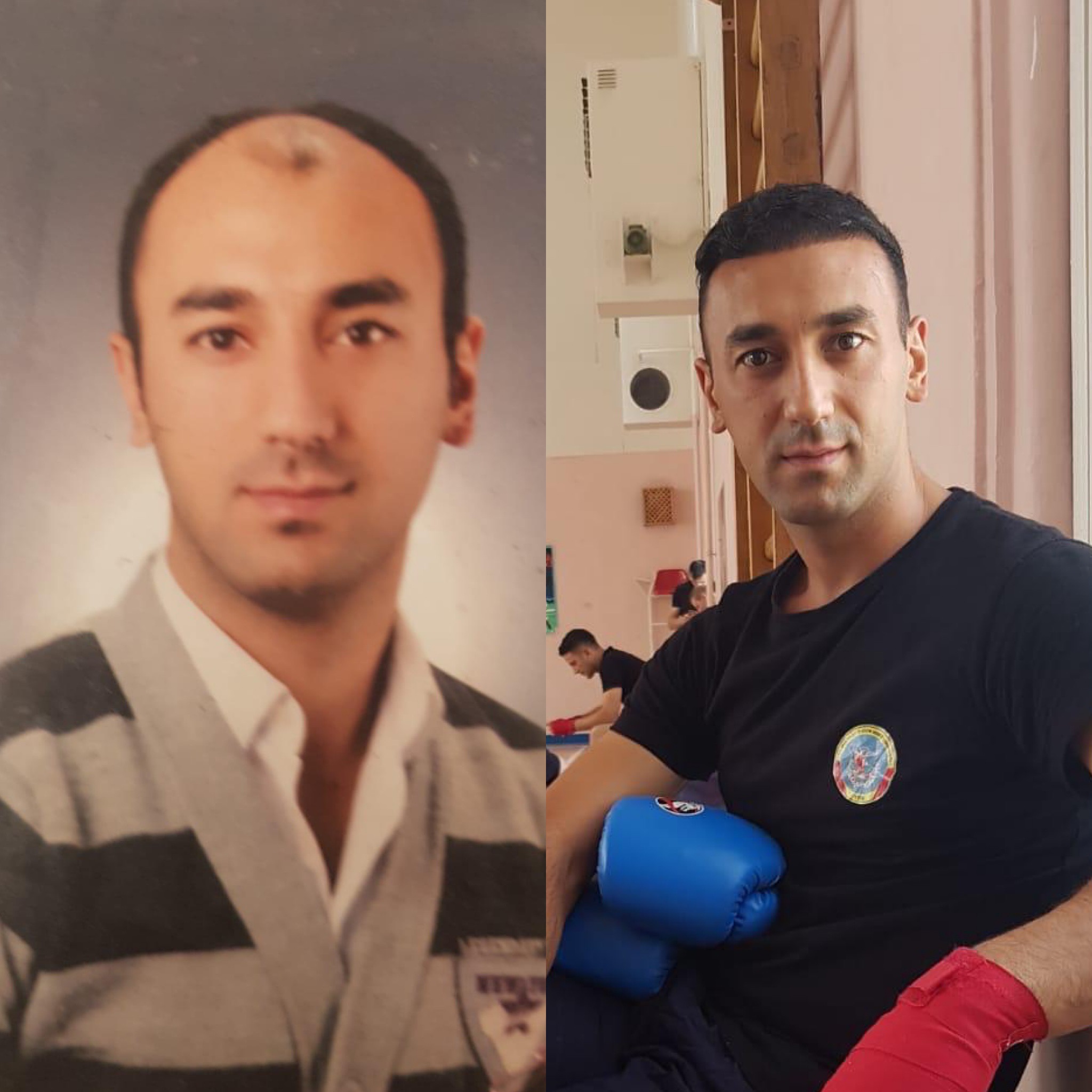 نتائج زراعة الشعر قبل وبعد في عيادة Suzermed – استعادة خط الشعر لدى المريض
