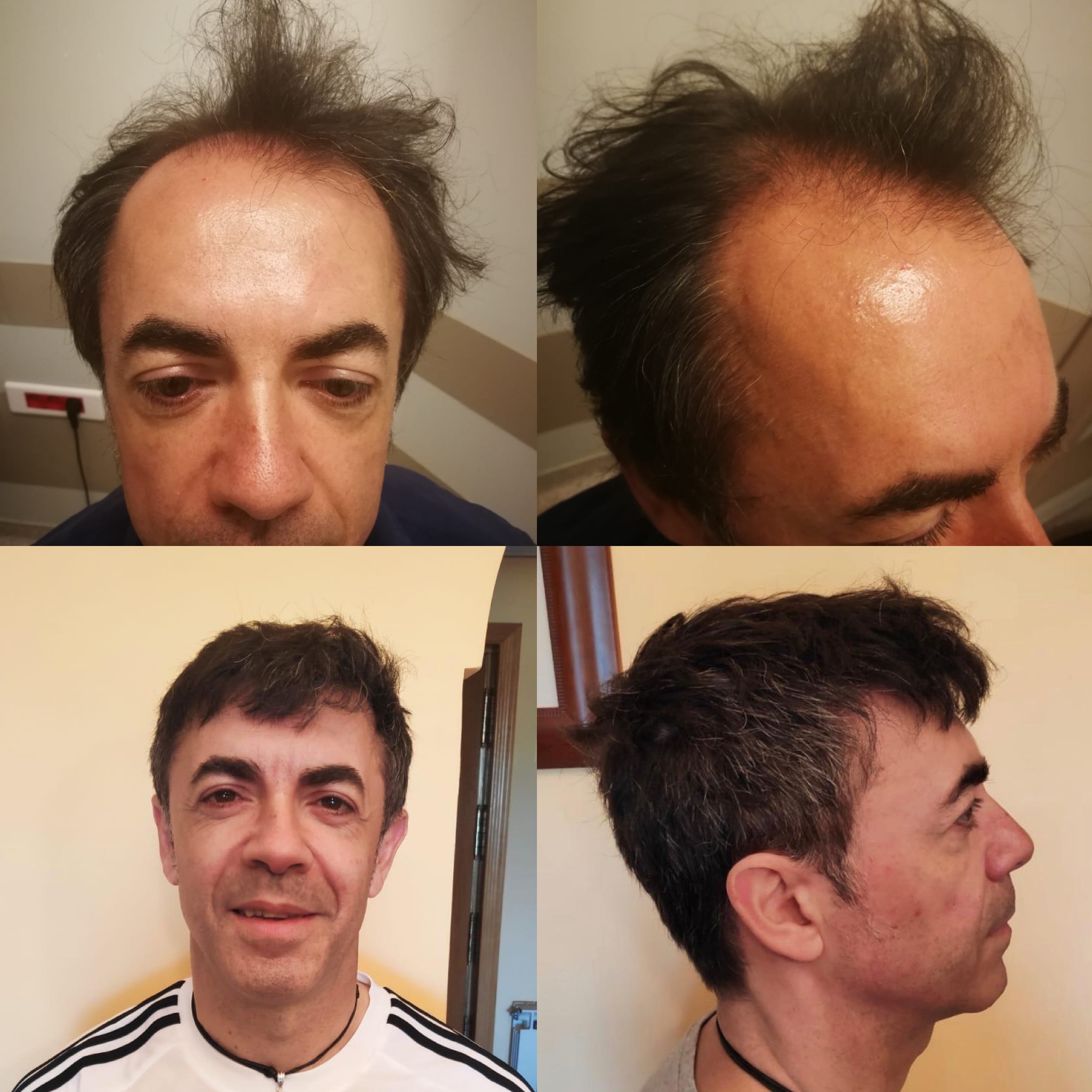 Resultados antes y después de trasplante capilar DHI en Suzermed Clinic, línea capilar restaurada