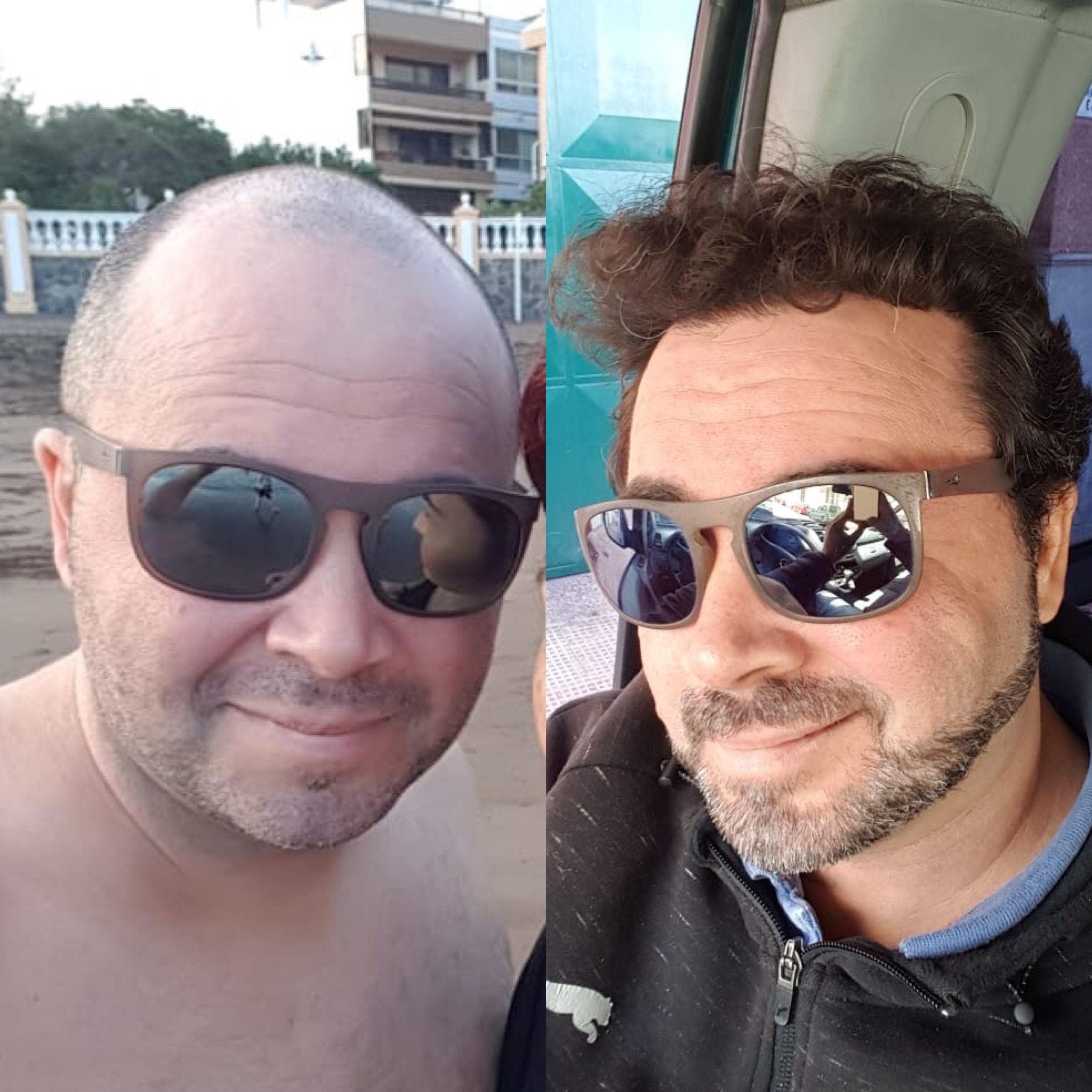 Resultados antes y después de trasplante capilar DHI en Suzermed Clinic – línea restaurada