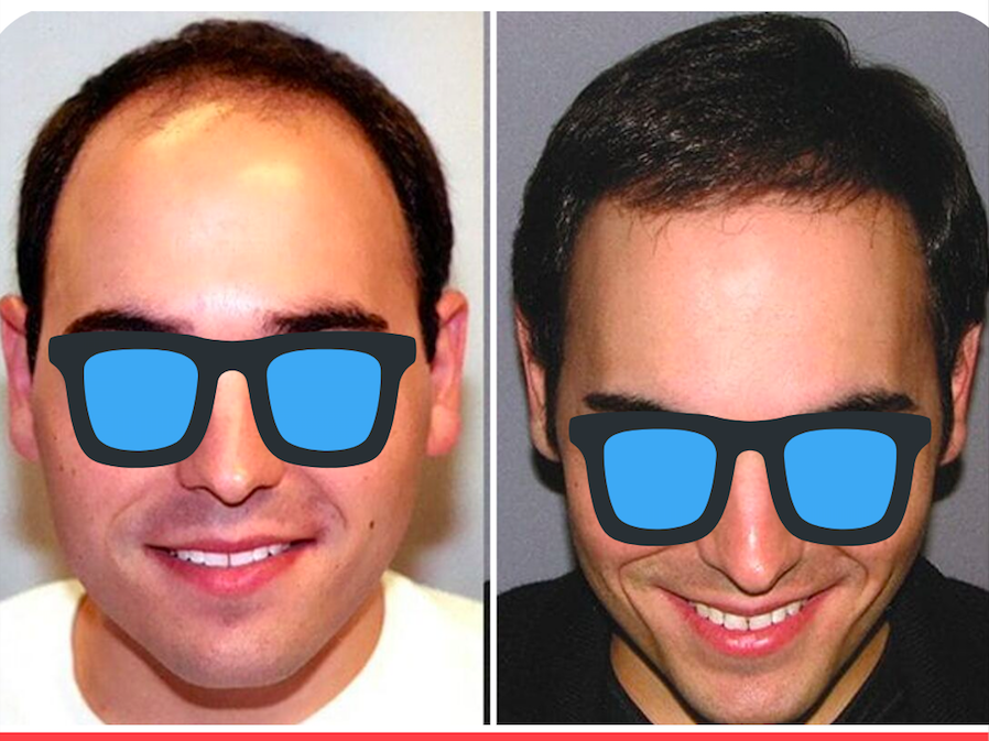 Hair Transplant In Germany 2 Clinics Compare Costs And Reviews