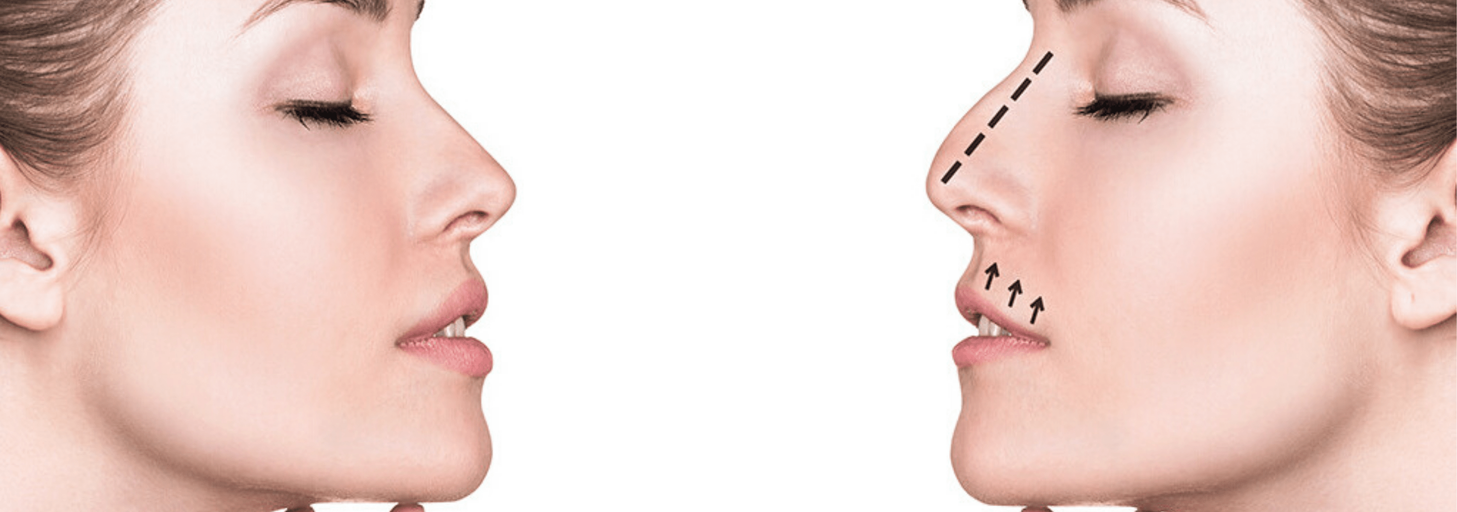 Top 5 Cheapest Countries For Rhinoplasty Nose Job In The World