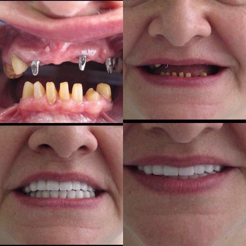 Результат до и после имплантации All-on-4 в Dentisland Oral and Dental Center, восстановленная улыбка