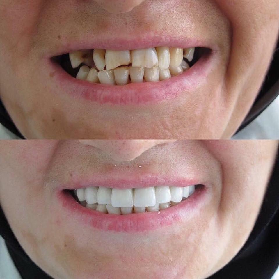 نتائج قبل وبعد تركيب تيجان البورسلين في مركز Dentisland لطب الأسنان، تغيير الابتسامة