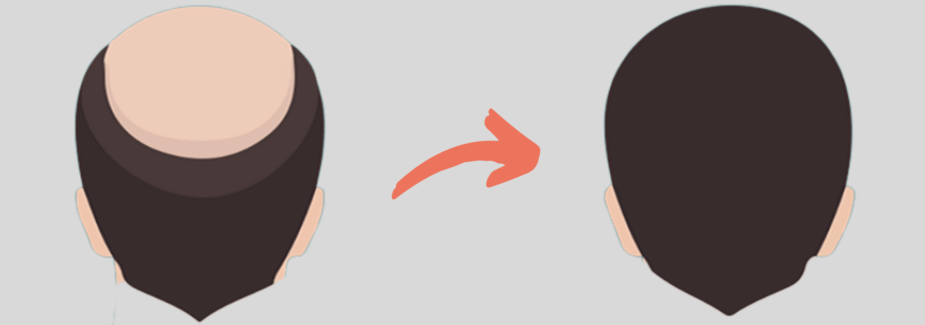 Top 5 Places To Get The Cheapest Hair Transplant In The World