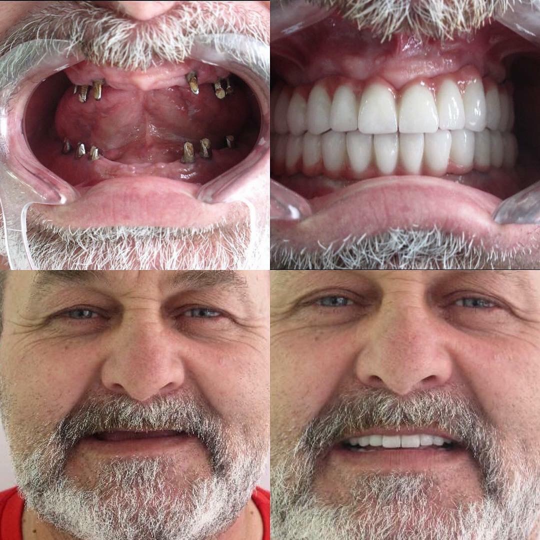 Résultat avant et après implants All-on-6 au Dentisland Oral and Dental Center, sourire restauré