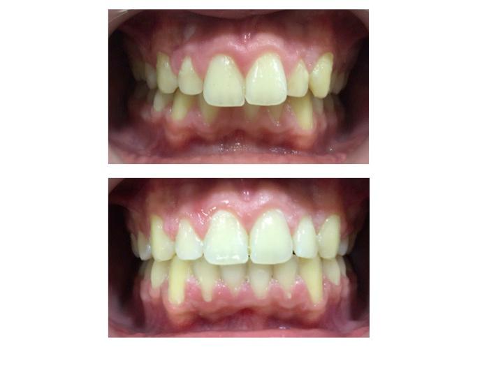 Resultados antes y después de carillas de composite en Dentisland Oral and Dental Center, mejora de sonrisa