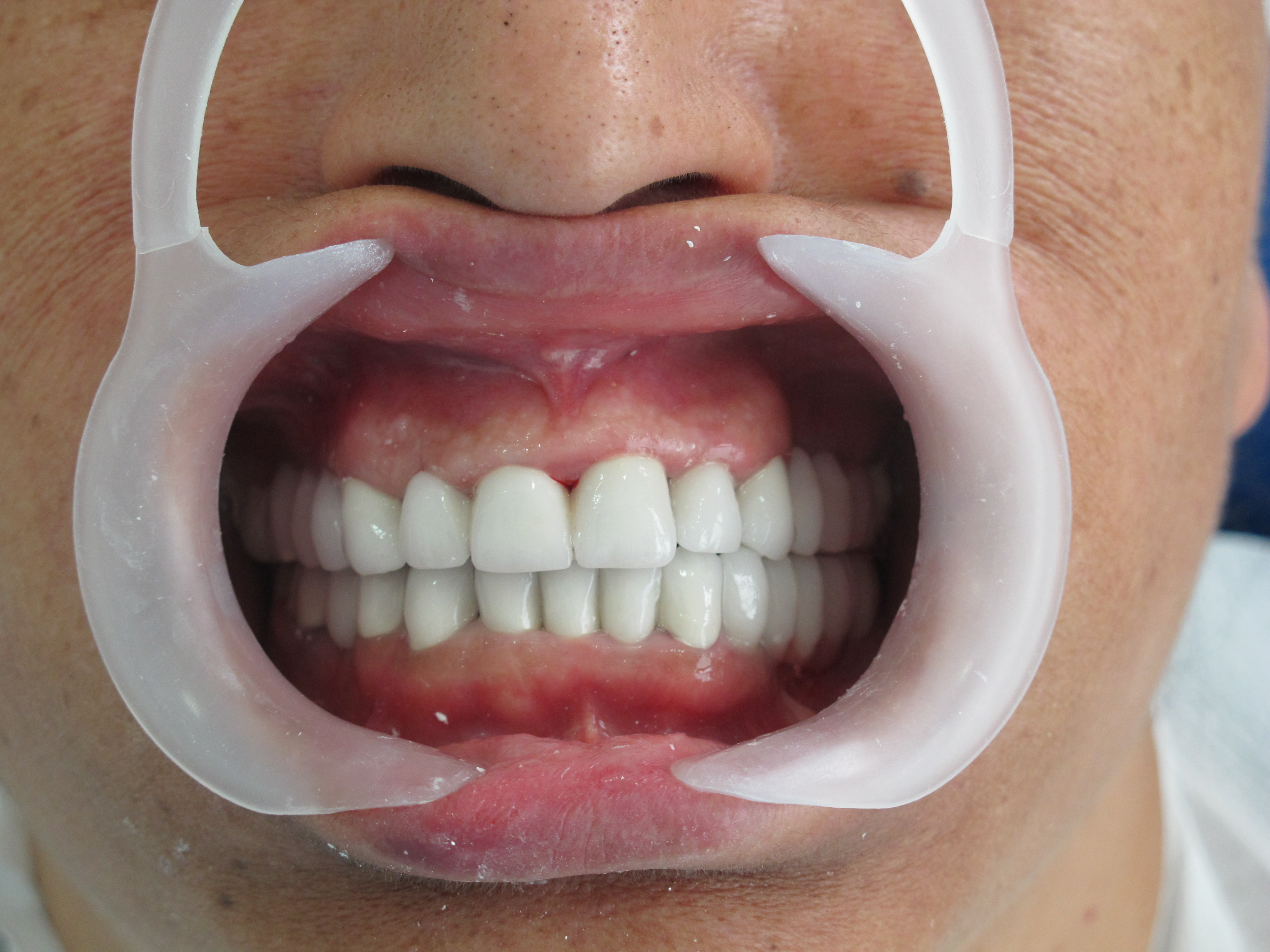 نتيجة تركيب تيجان البورسلين في Dentisland Oral and Dental Center، ابتسامة محسنة
