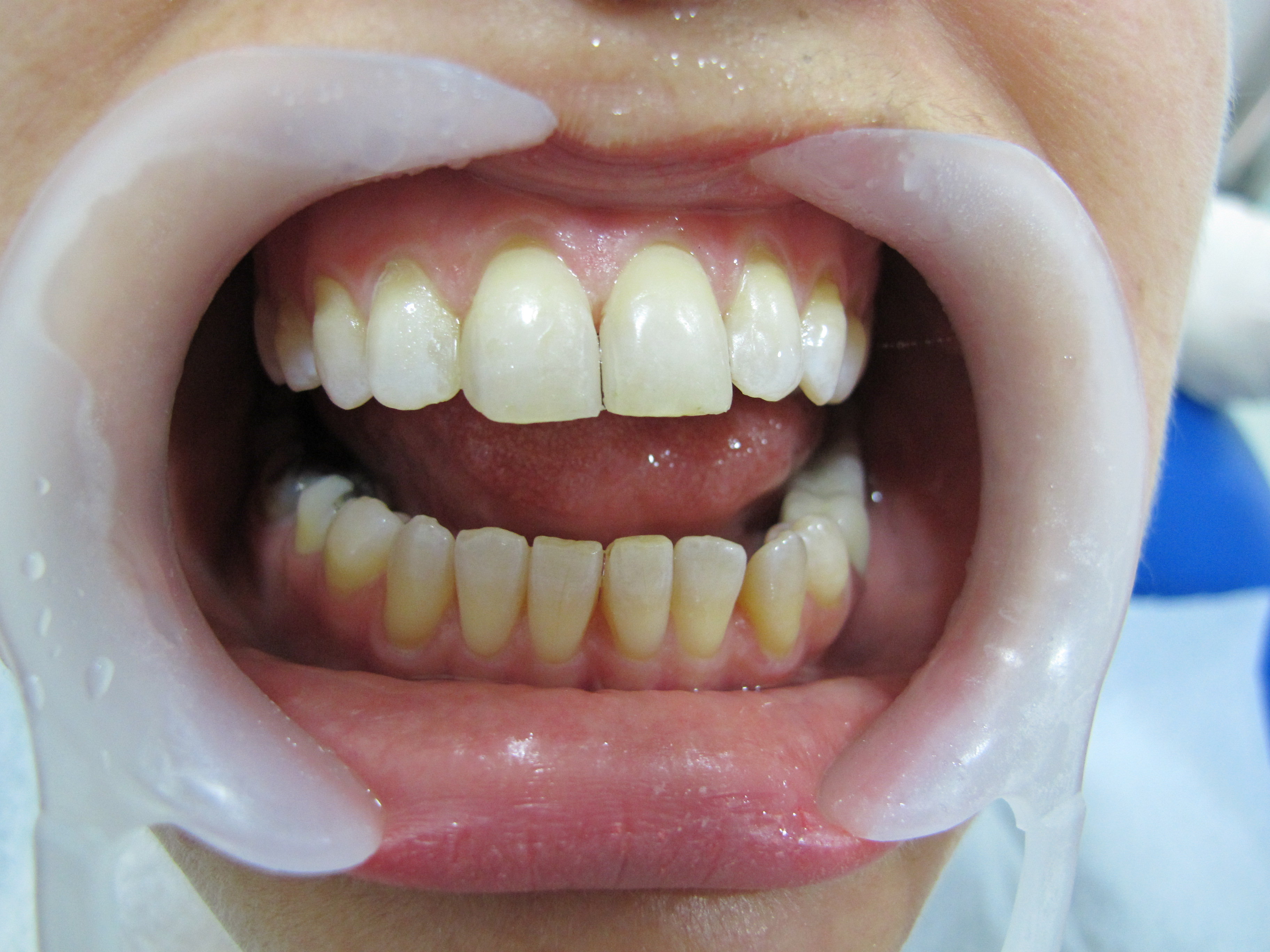 Tooth restoration (bonding) result at Dentisland Oral and Dental Center, improved tooth shape