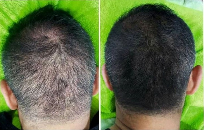 Результаты мезотерапии волос в ClinicHair до и после – заметное увеличение густоты волос
