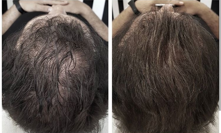 До и после мезотерапии волос в ClinicHair – заметное улучшение густоты волос