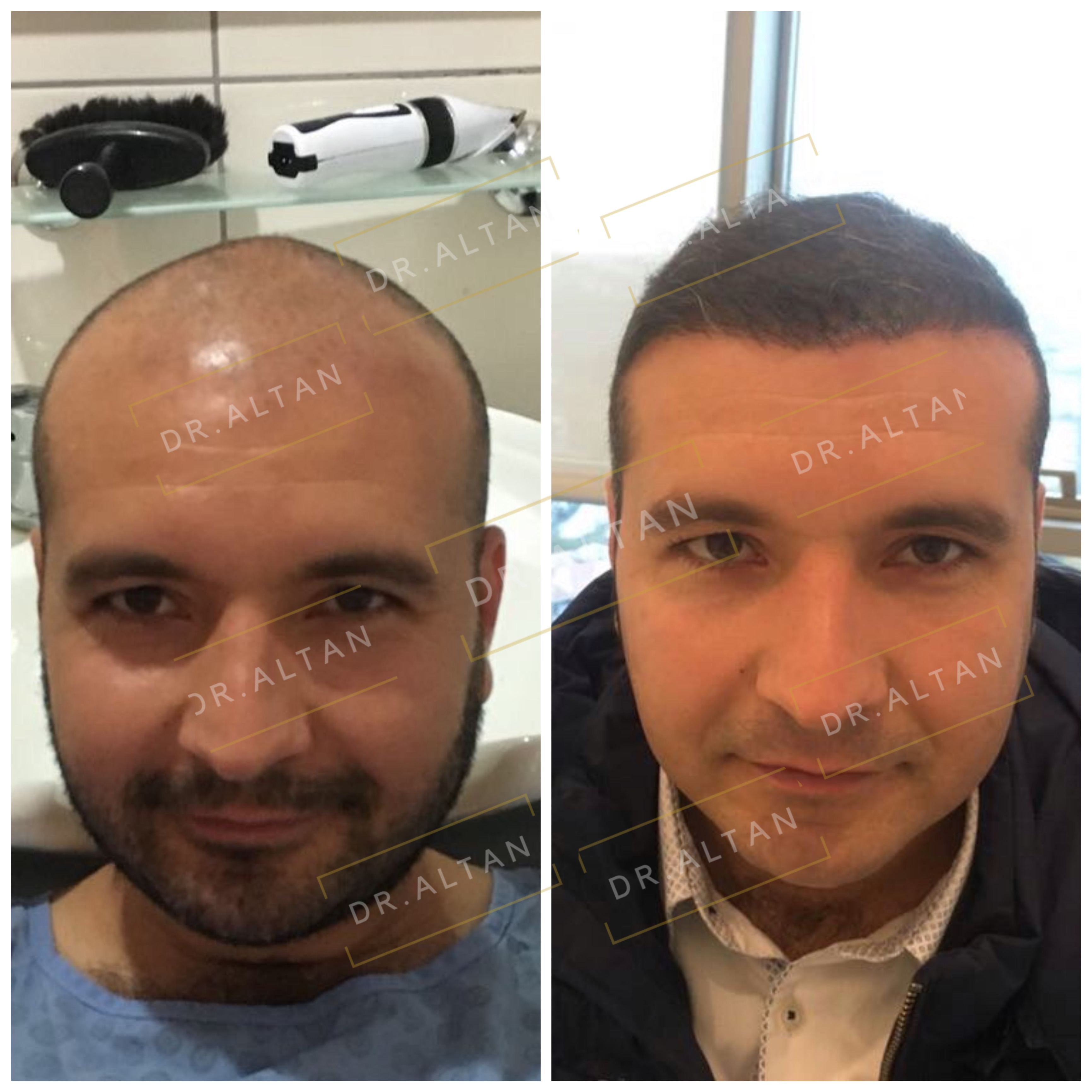 نتائج زراعة الشعر قبل وبعد في عيادة Aestepool، استعادة خط الشعر الممتلئ