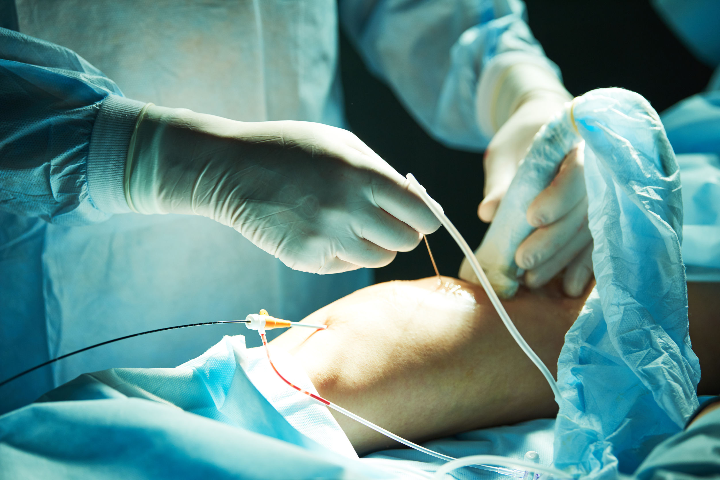 إجراء علاج الدوالي EVLA في Vein Clinic Alanya و Dr. ZAN Vein Clinic Antalya