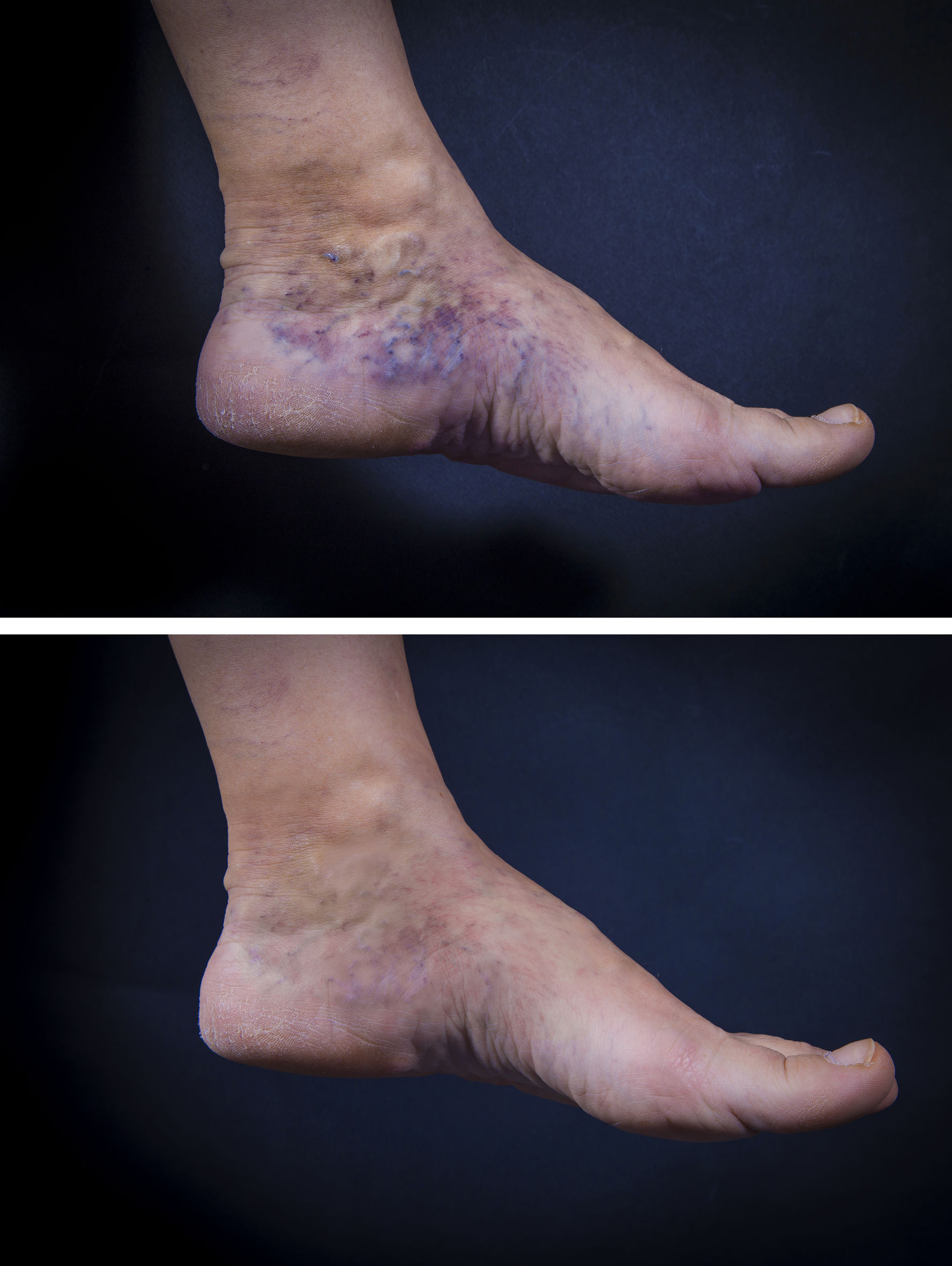 Before and after sclerotherapy for varicose veins at Vein Clinic Alanya & Dr. ZAN, visible result