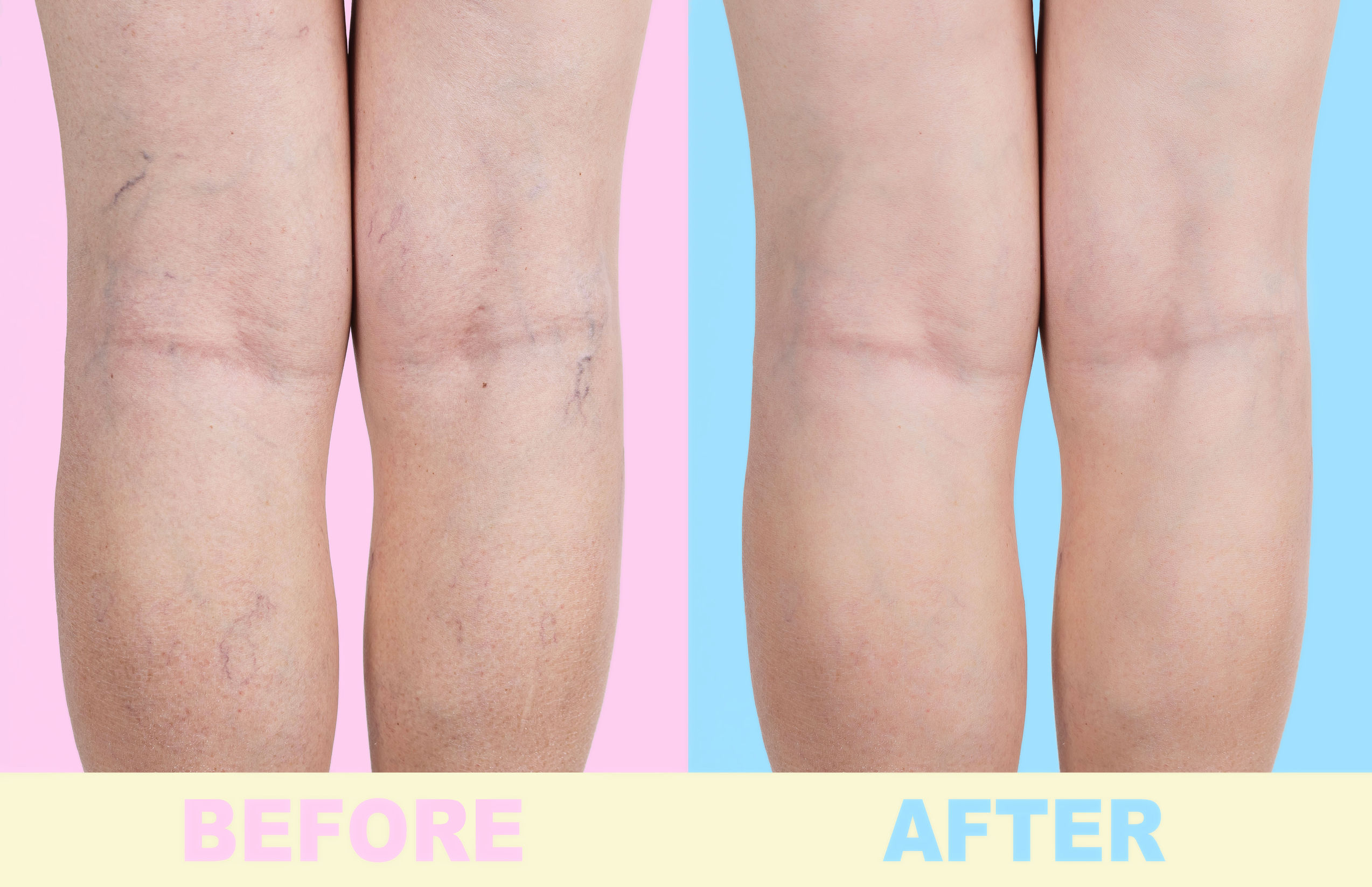 Résultats avant et après le traitement des varices à Vein Clinic Alanya & Dr. ZAN Vein Clinic Antalya