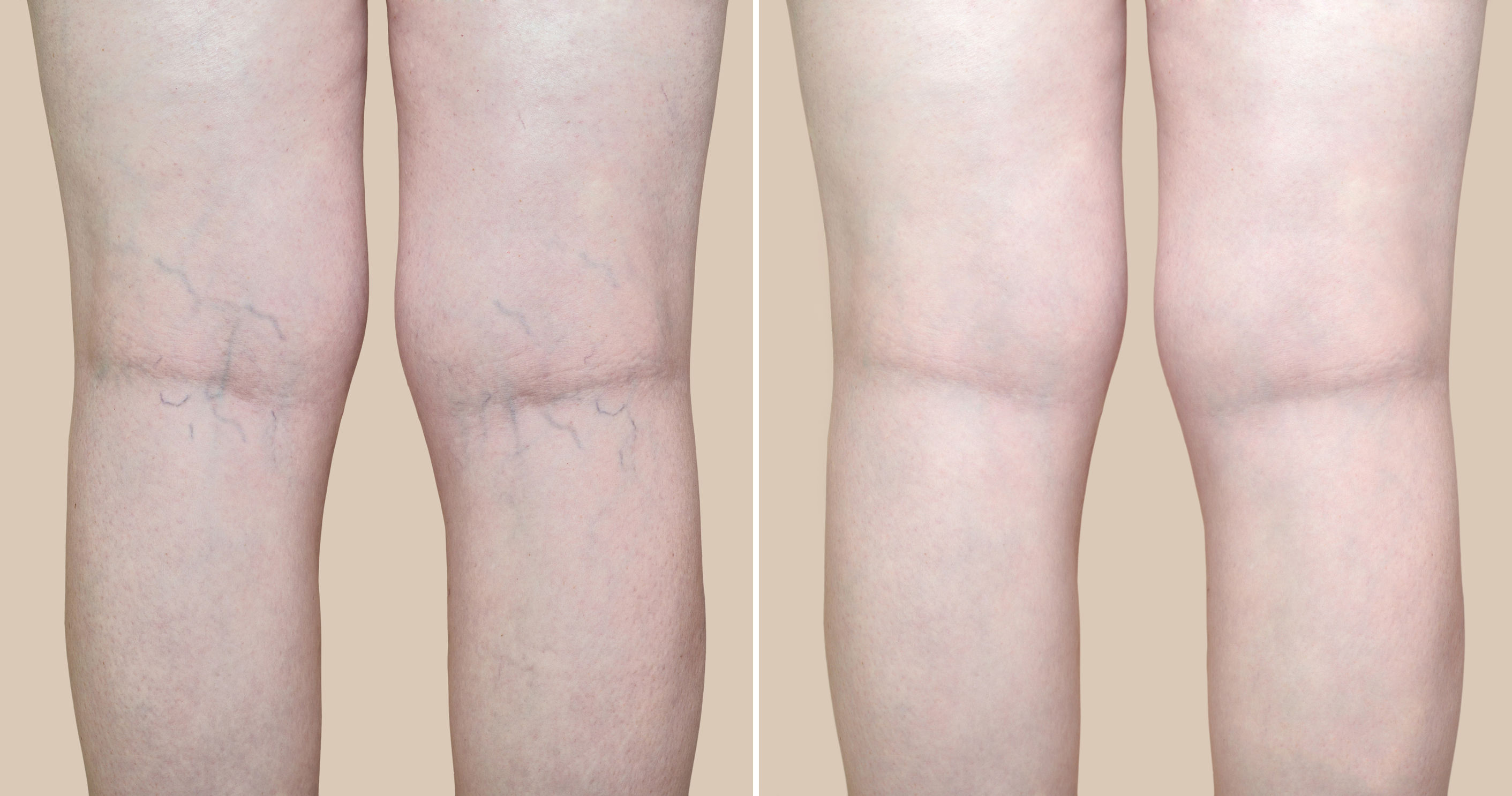Before and after varicose veins removal results at Vein Clinic Alanya & Dr. ZAN Vein Clinic Antalya
