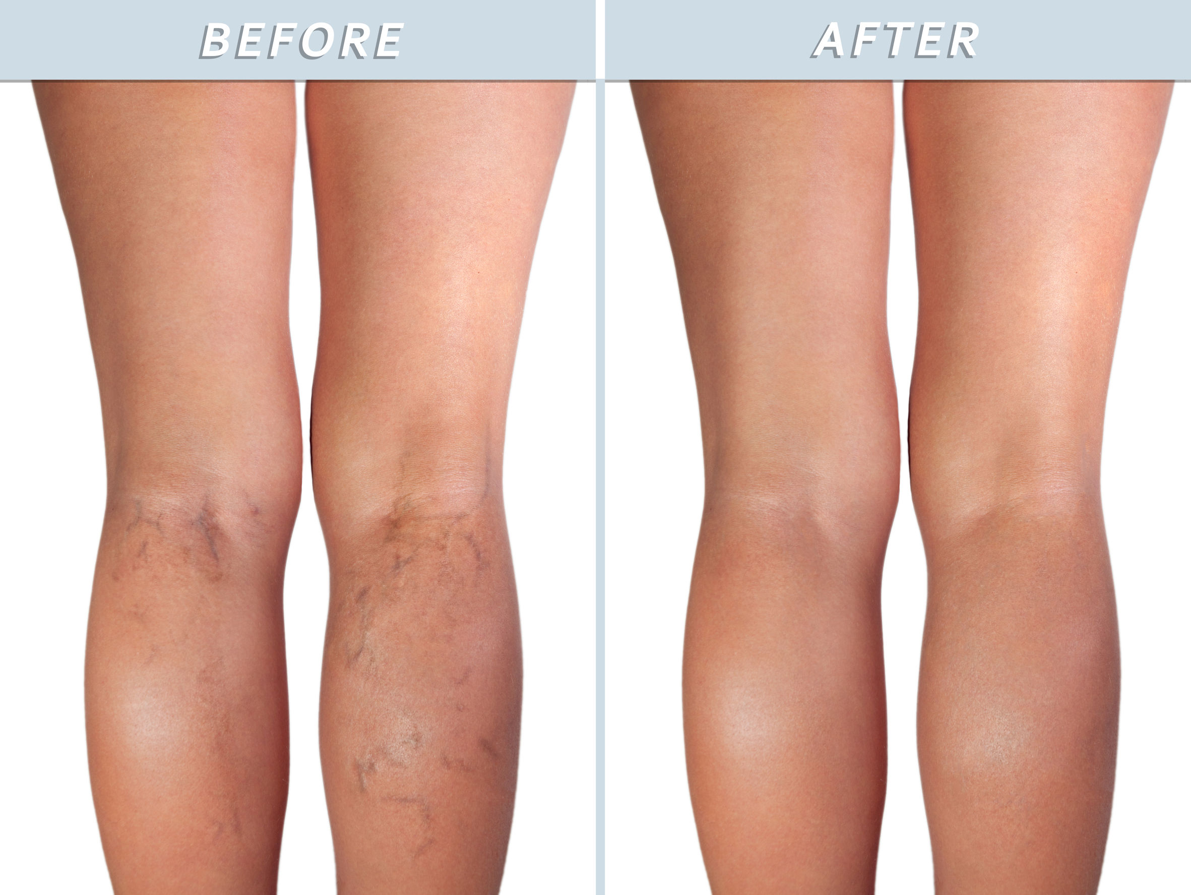 Before and after varicose veins removal results at Vein Clinic Alanya & Dr. ZAN Vein Clinic Antalya