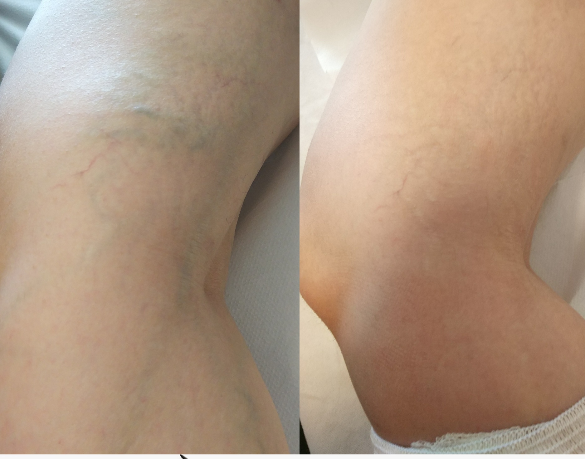 Resultados antes y después de la eliminación de varices en Vein Clinic Alanya & Dr. ZAN Vein Clinic Antalya