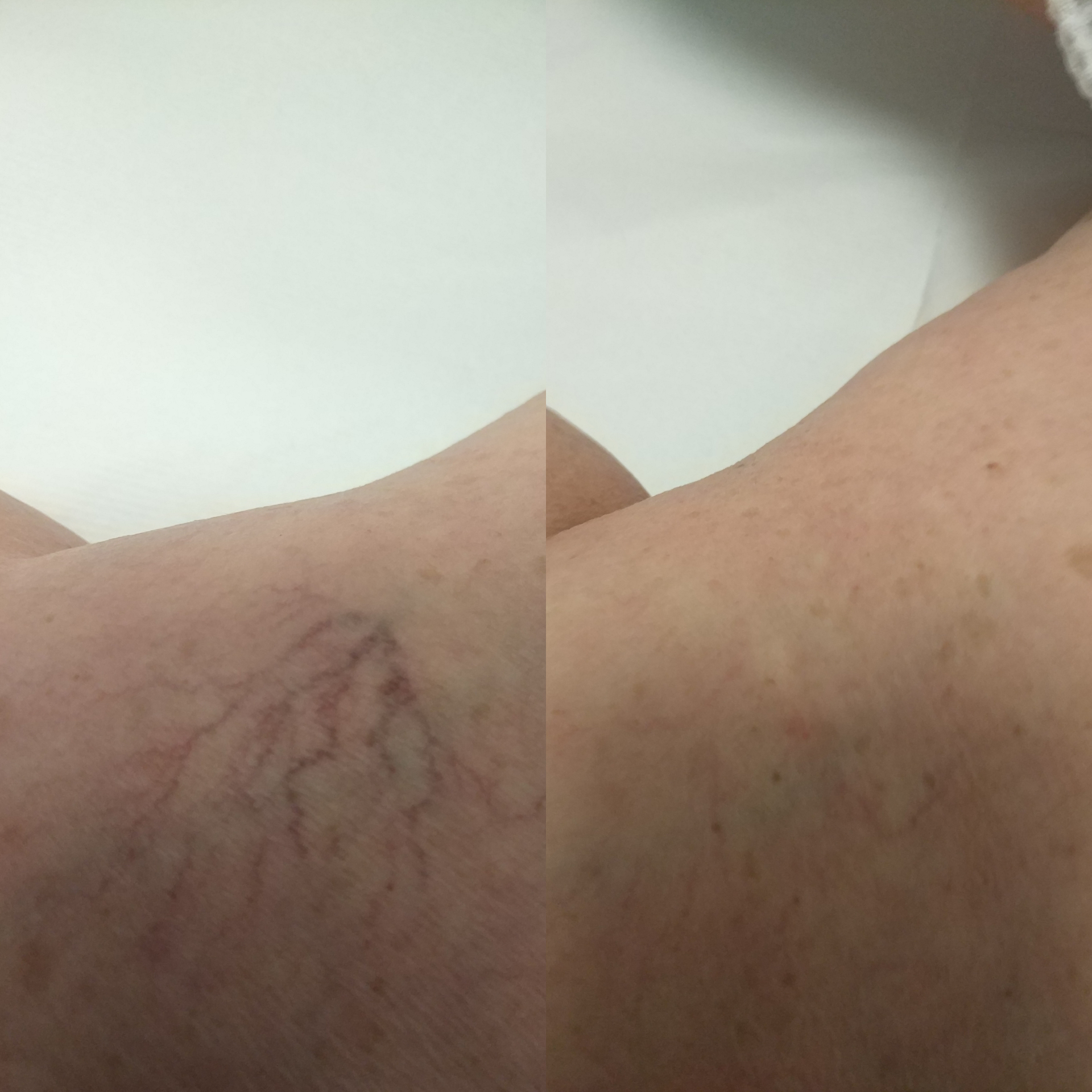 Результати до і після видалення варикозних вен у Vein Clinic Alanya та Dr. ZAN Vein Clinic Antalya