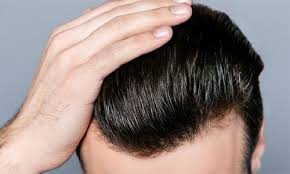 FUE hair transplant result at Crown Health Group – natural, fuller hairline after procedure