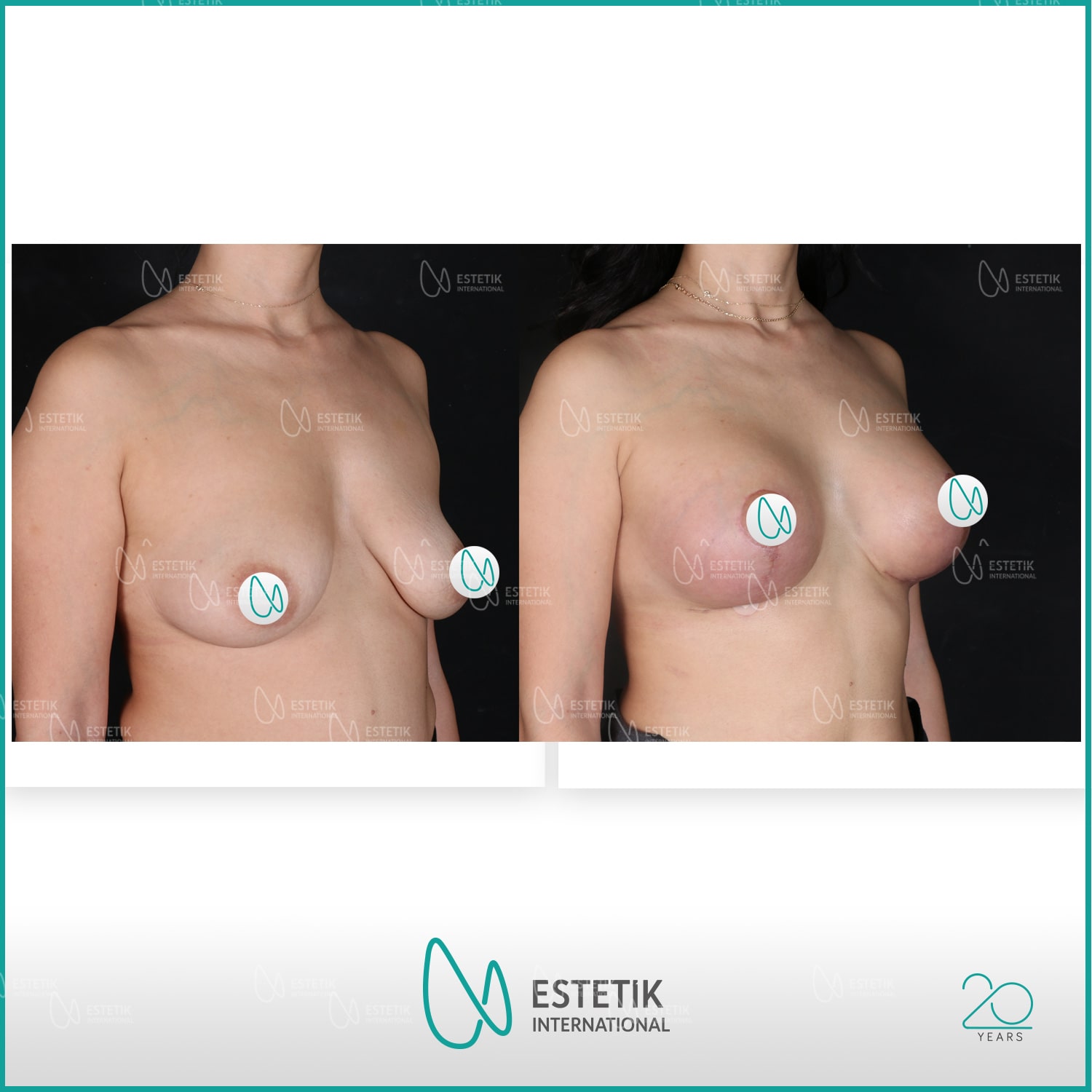 Результат до и после подтяжки груди с имплантами в Estetik International Istanbul, улучшенная форма
