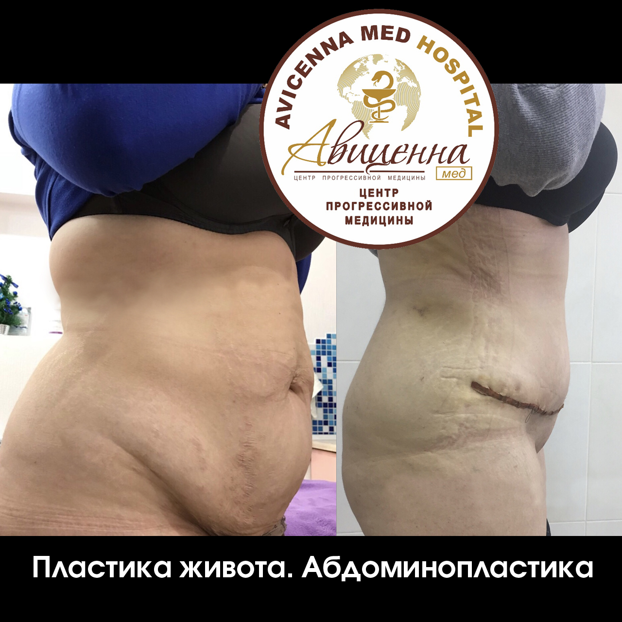 Resultados de abdominoplastia antes y después en Avicenna Med, contorno abdominal visible