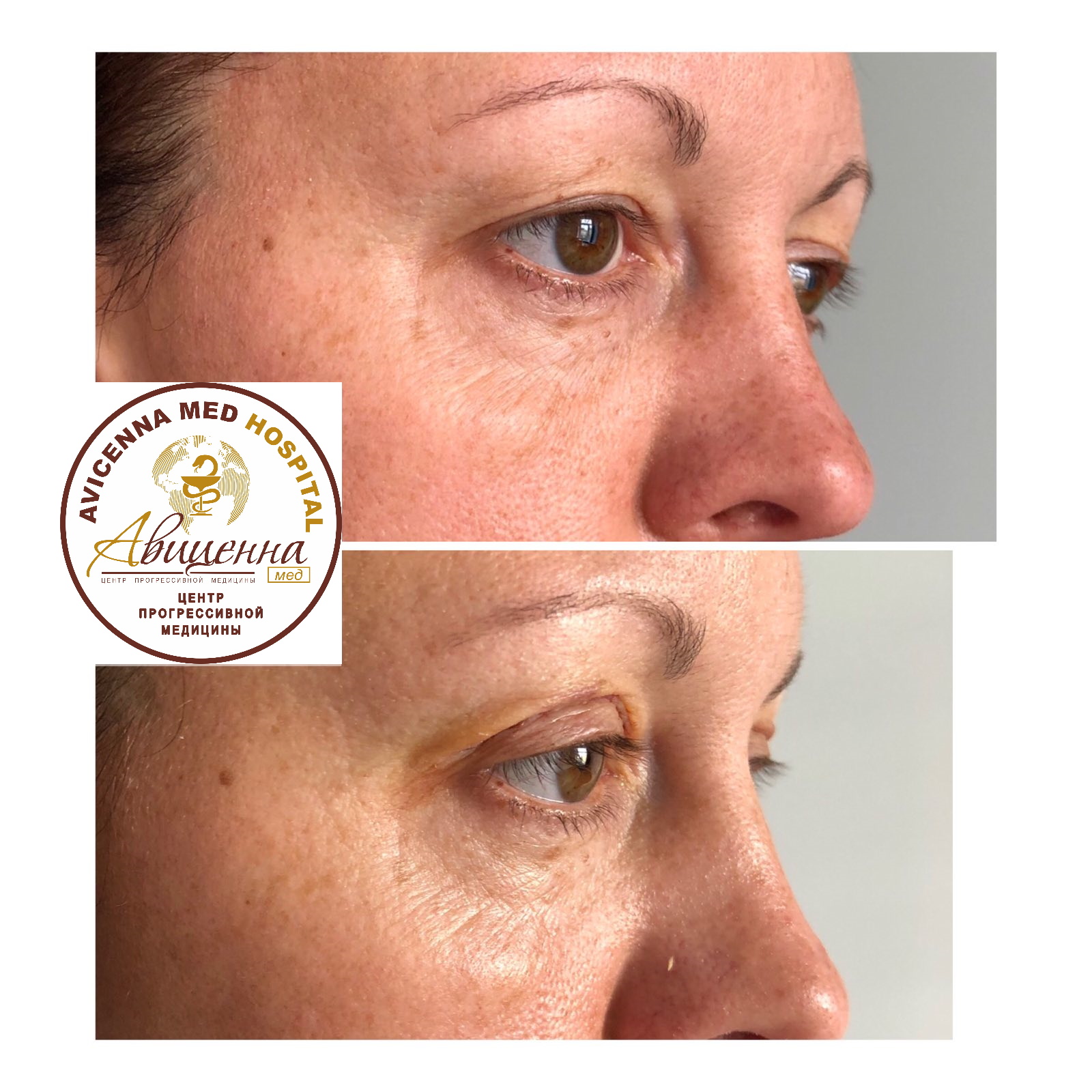 Facelift before and after results at Avicenna Med Medical Center, visible facial rejuvenation