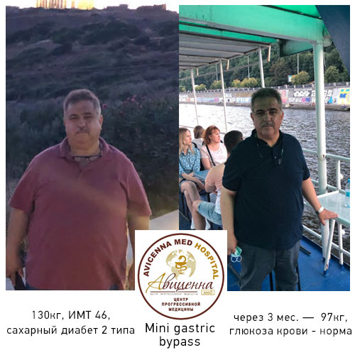 Mini gastric bypass before and after results at Avicenna Med Medical Center, visible weight loss