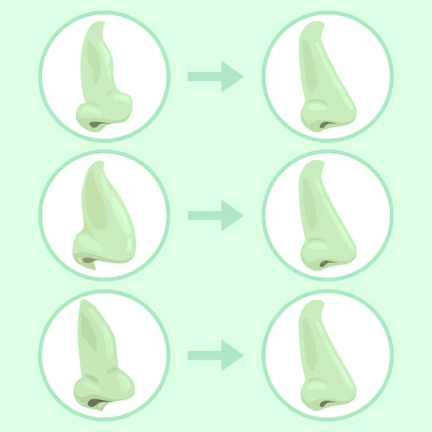 que problemas puede corregir la rinoplastia
