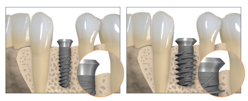 Implante dental de titanio de la marca Straumann 