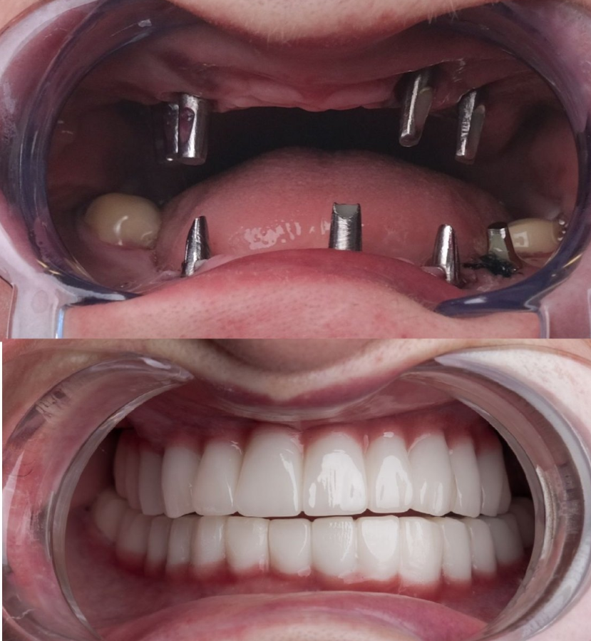 Implantes dentales en Turquía All-on-4, cambio de sonrisa, 4 implantes dentales en cada mandíbula