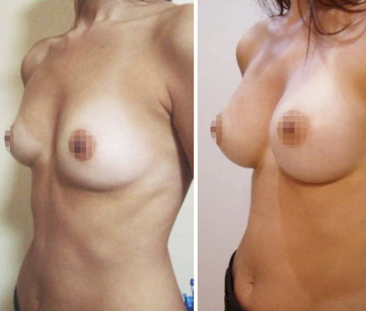 aumento de pecho en turquia antes y despues